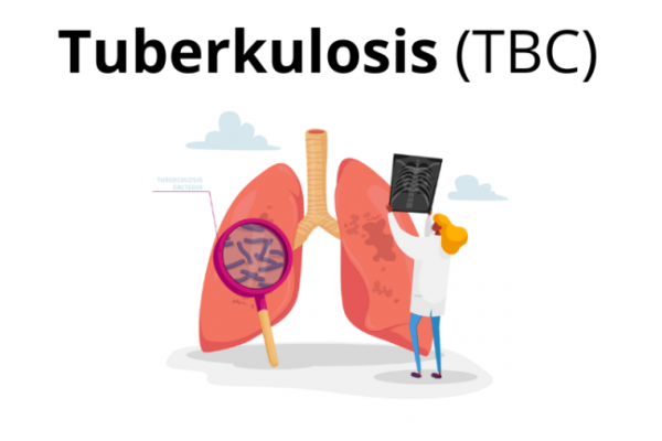 TBC masih menjadi masalah global, terutama karena kaitannya yang erat dengan status gizi dan berat badan penderita atau pasien