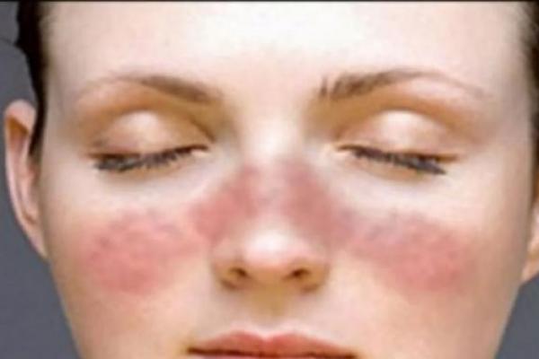Mengapa Lupus Disebut Penyakit Seribu Wajah? Ini Penjelasannya