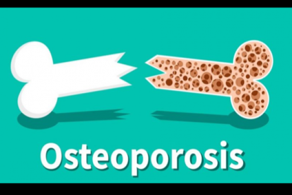 Mengapa Hari Osteoporosis Sedunia Diperingati Setiap 20 Oktober?