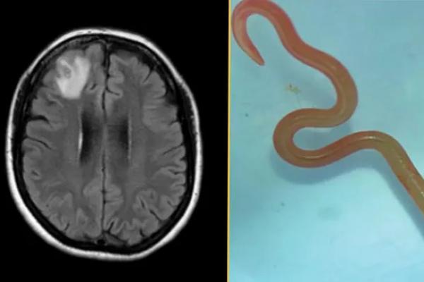 Kasus medis langka di Australia, cacing ular yang belum pernah menginfeksi manusia ditemukan hidup di otak seorang wanita