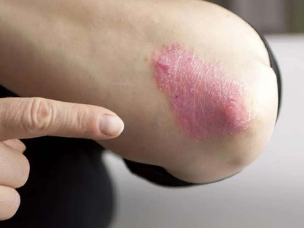 Mengenal Hari Psoriasis Sedunia yang Diperingati Setiap 29 Oktober